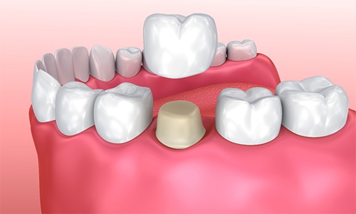 animation of dental crown placement