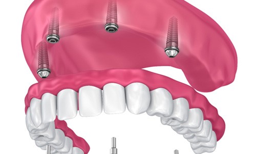 full implant denture replacing upper arch of teeth