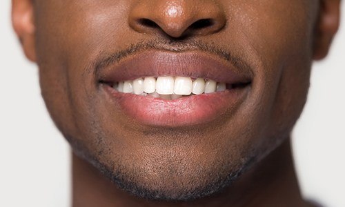 Closeup of smile with tooth-colored fillings near Marathon