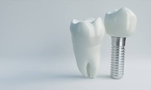 Diagram showing dental implant standing next to a natural tooth