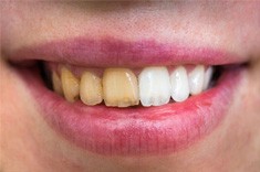 Before and after teeth whitening results