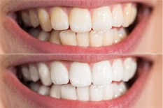 Before and after teeth whitening results