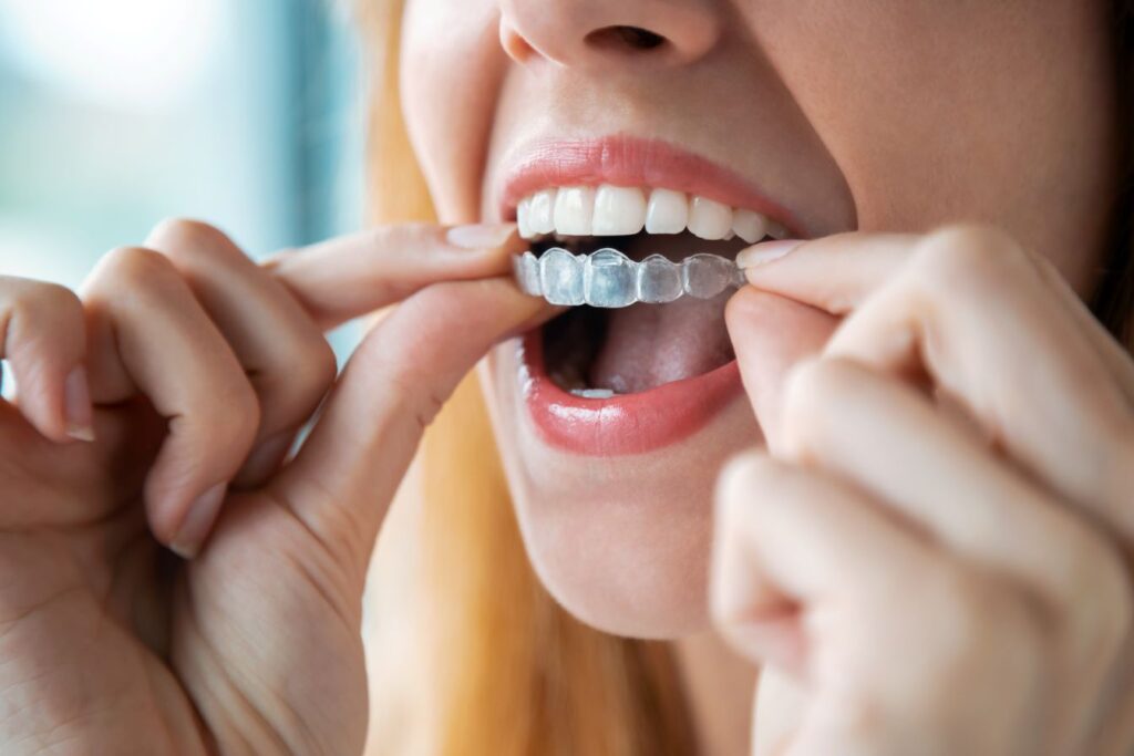 A woman putting on an Invisalign aligner